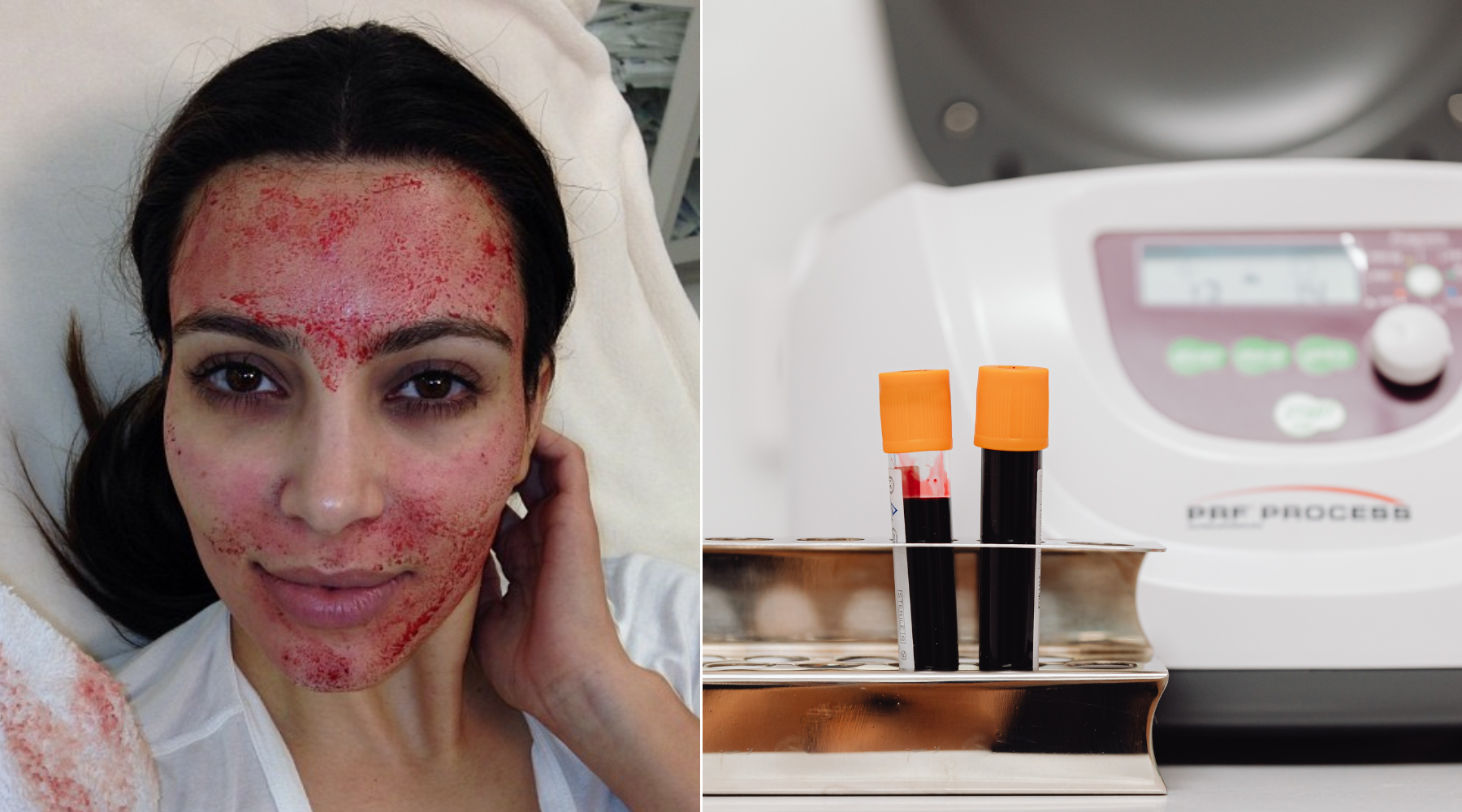 Vampire facial: Bizarni tretman lica?