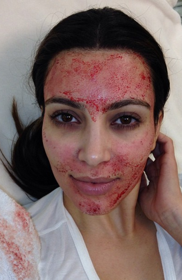 Vampire facial: Bizarni tretman lica?