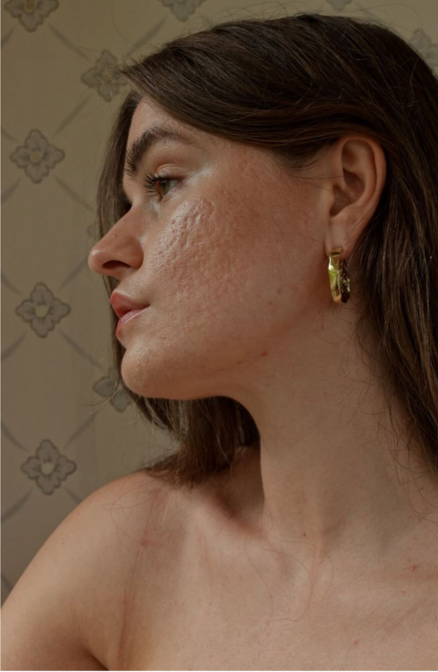 Acne-safe skin care rutina za osetljivu kožu – izdvajamo favorite